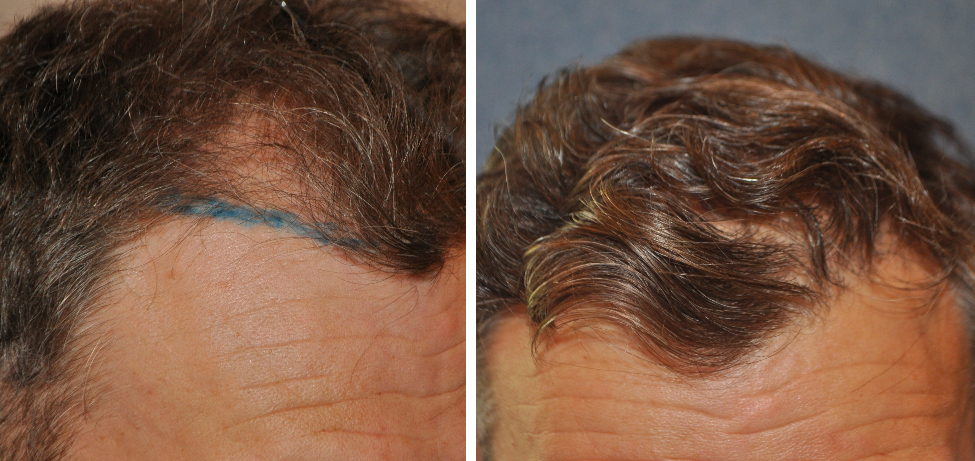 How to know if you have male pattern baldness genes