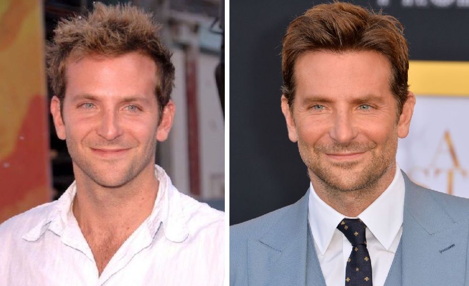 Bradley Cooper hair transplant