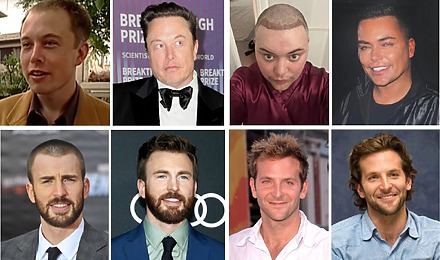 Celebrity Hair Transplants