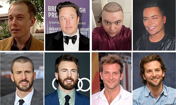 celebrity hair transplants