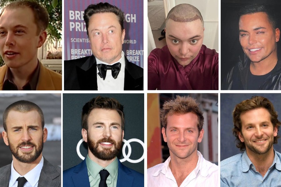 Celebrity Hair Transplants