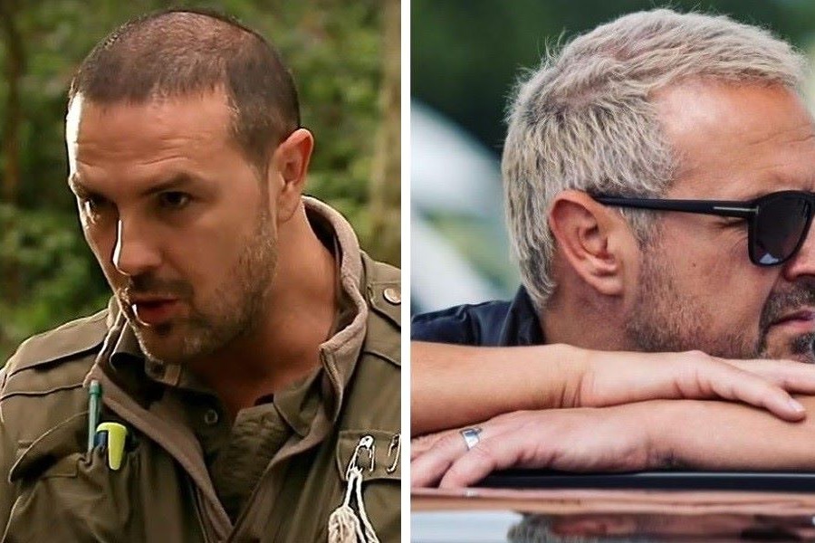 Paddy McGuinness Hair Transplant
