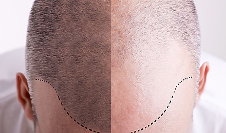 Scalp Micropigmentation