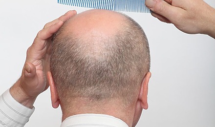 Where Does Hair Transplant Hair Come From