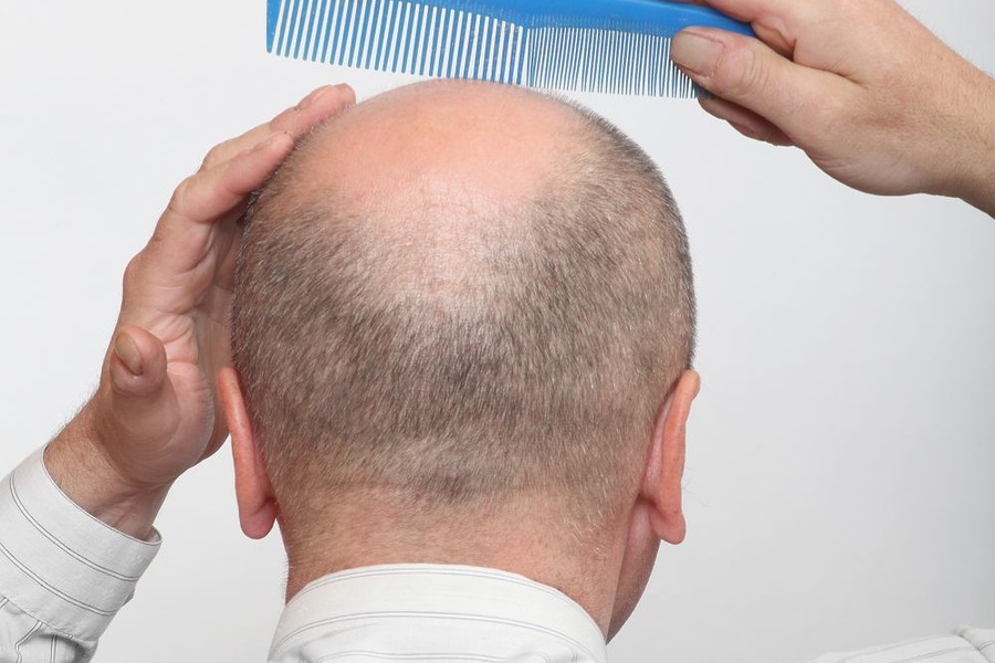 Where Does Hair Transplant Hair Come From
