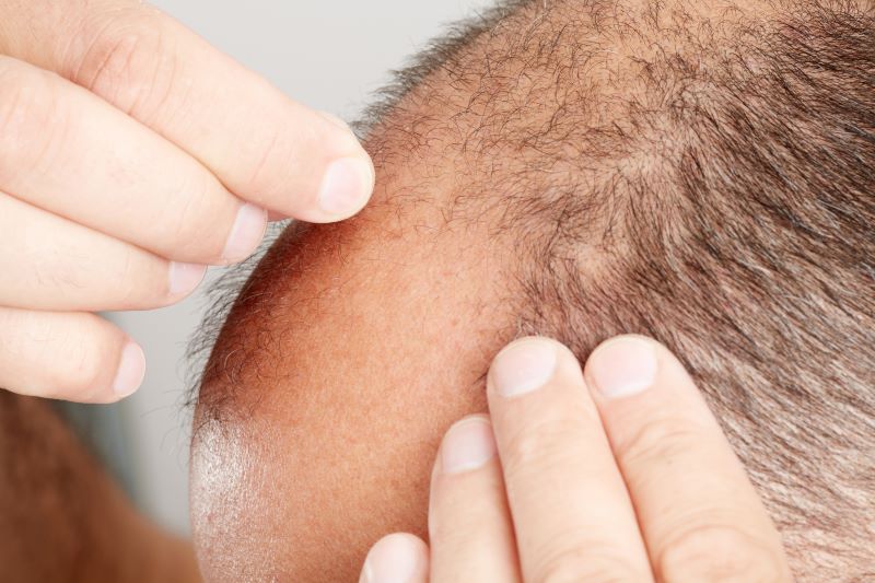 Healthy donor hair is important when assessing hair transplant candidates