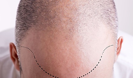 Hair Transplant Hairline