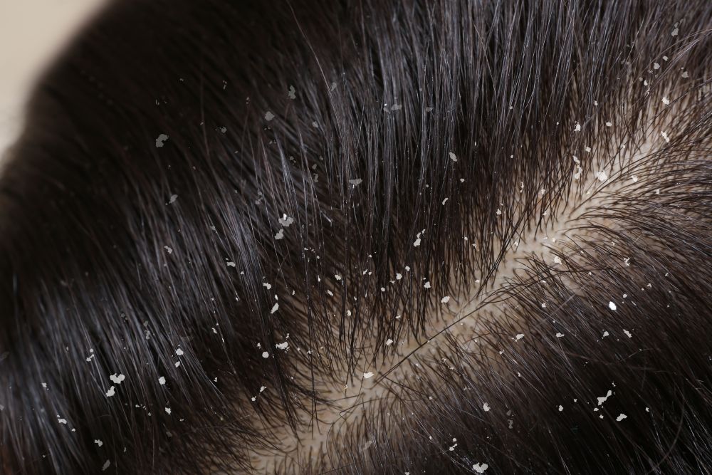 Dandruff on hair