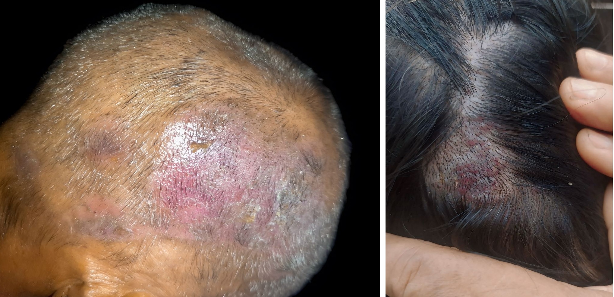 Examples of Tinea Capitis