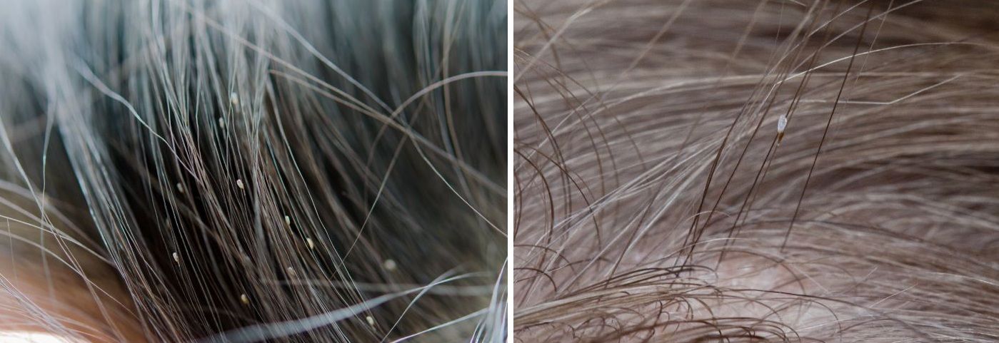 Lice and nits in hair