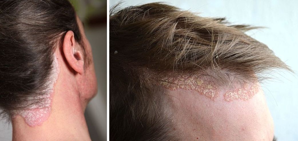 Psoriasis on the hairline