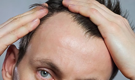 Hair Transplant Too Early