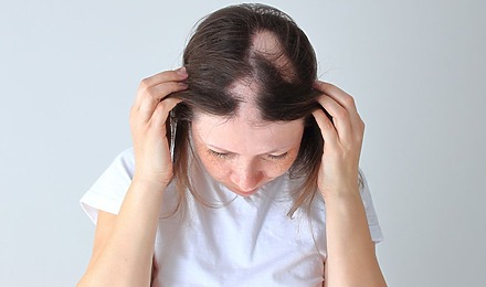 Alopecia Areata