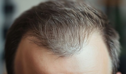 M Shaped Hairline