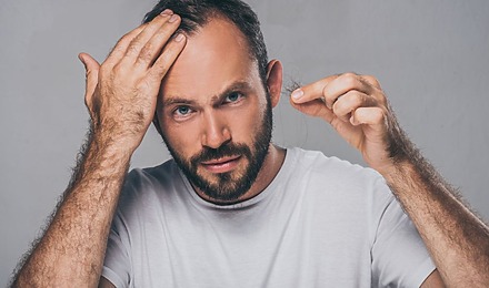 Androgenetic Alopecia