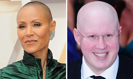 12 Celebrities With Alopecia: Dealing With Hair Loss