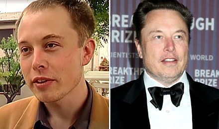 Elon Musk Hair Transplant