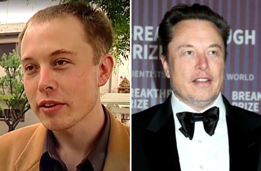 Elon Musk hair transplant