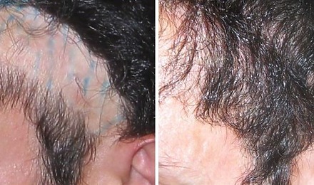Hair Transplant On Scar