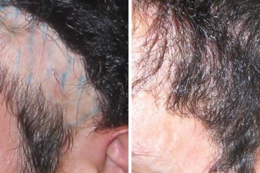 Hair Transplant On Scar