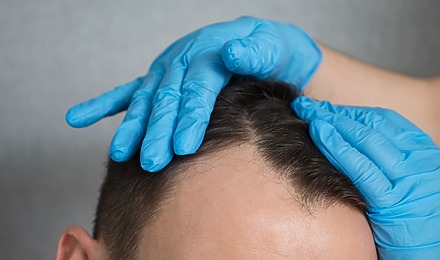 Temple Hair Loss