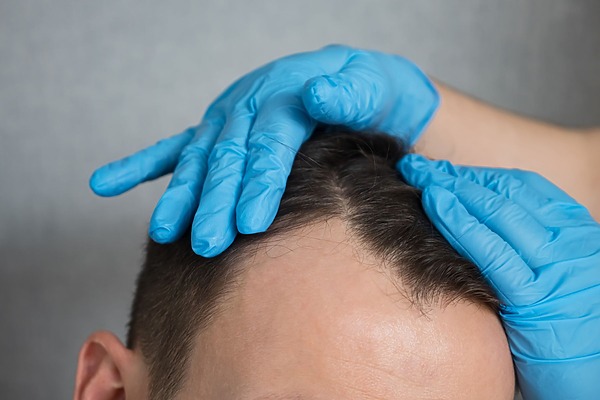 temple hair loss