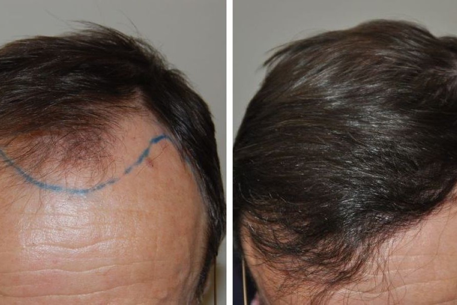 1500 Grafts Hair Transplant