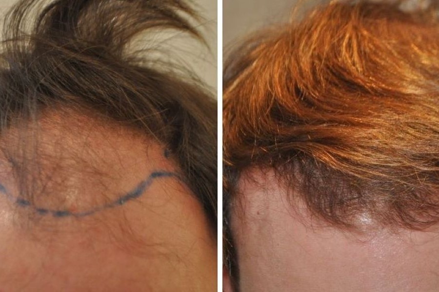 2000 Grafts Hair Transplant