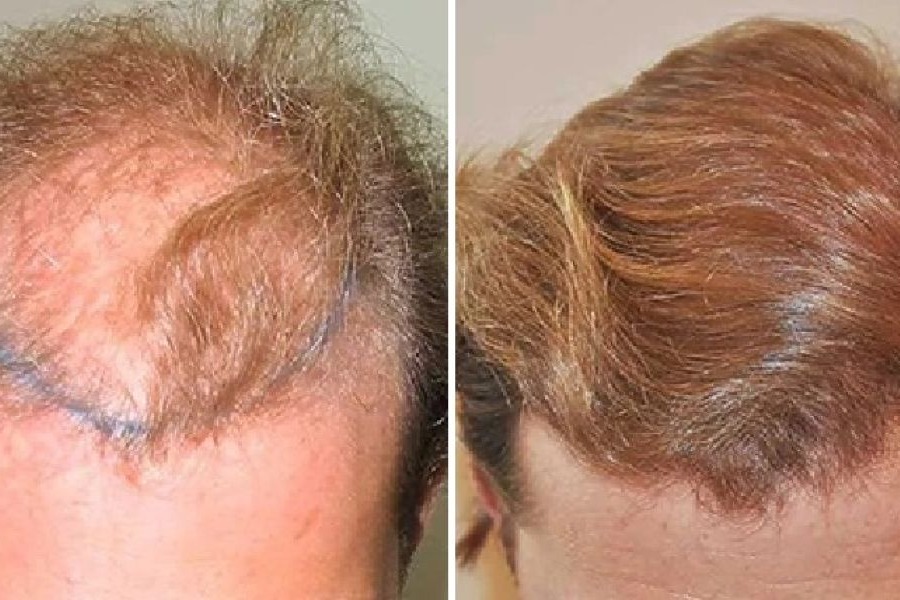 3000 Grafts Hair Transplant