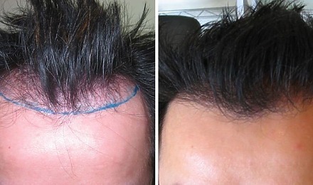1000 Grafts Hair Transplant