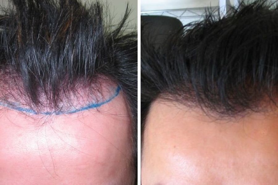 1000 Grafts Hair Transplant