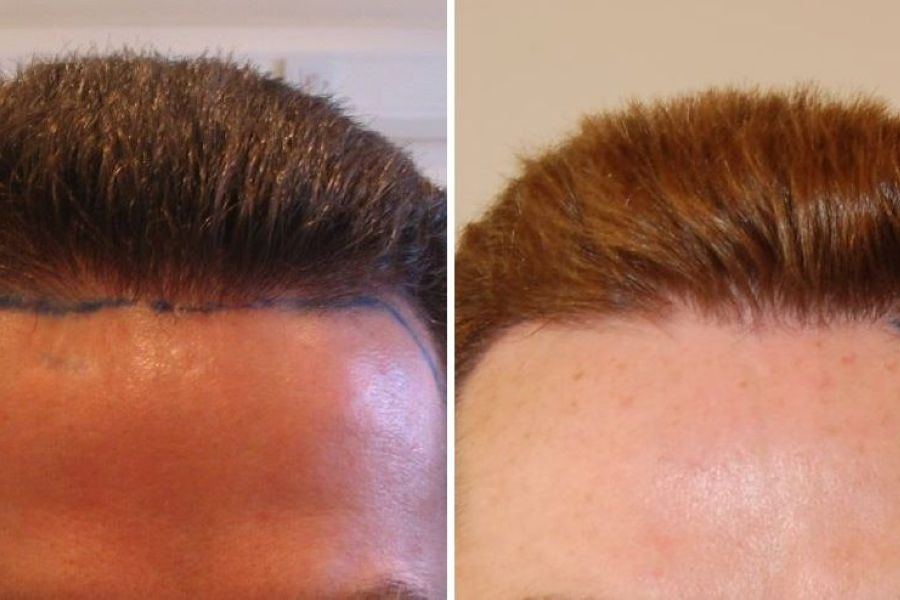 500 Grafts Hair Transplant
