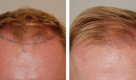 Hair Transplant After 4 Months