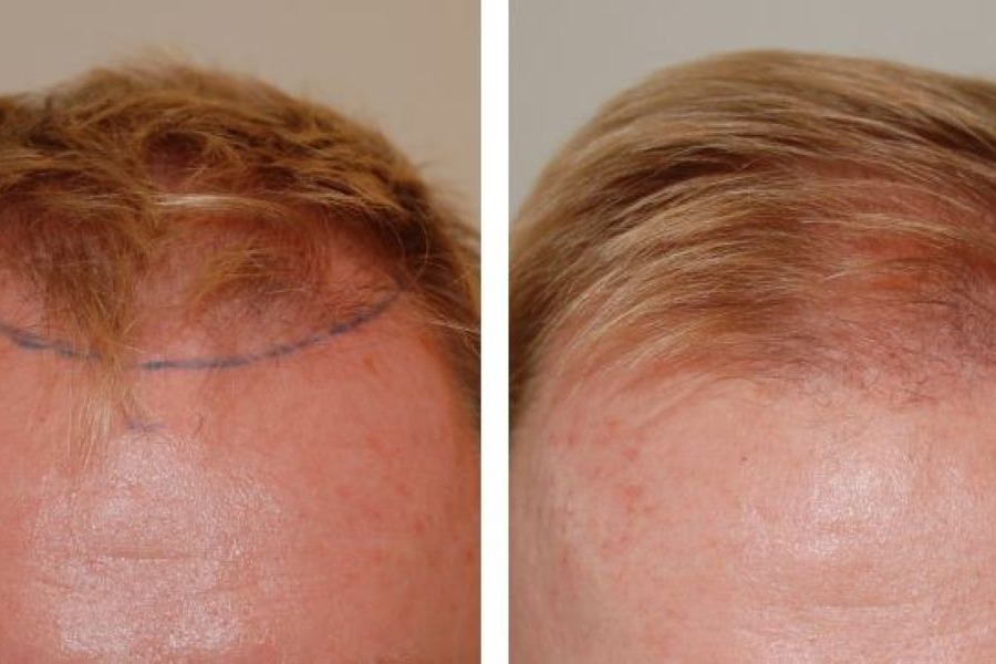Hair Transplant After 4 Months