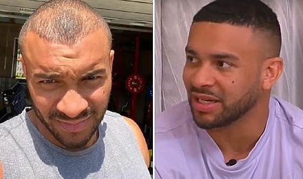 Jonathan Joseph Hair Transplant