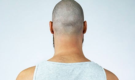 Retrograde Alopecia