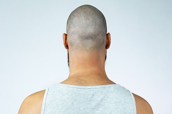 Retrograde Alopecia