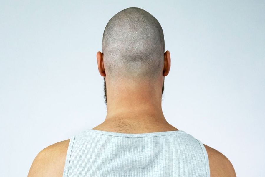 Retrograde Alopecia