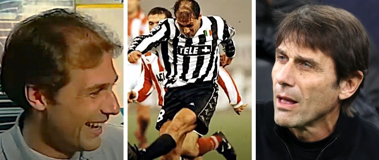 Antonio Conte before and after hair restoration