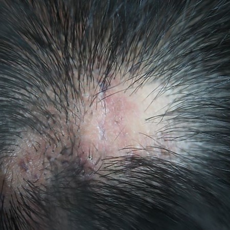 Lichen planopilaris on one side of the head