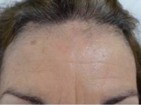 Receding hairline from frontal-fibrosing alopecia