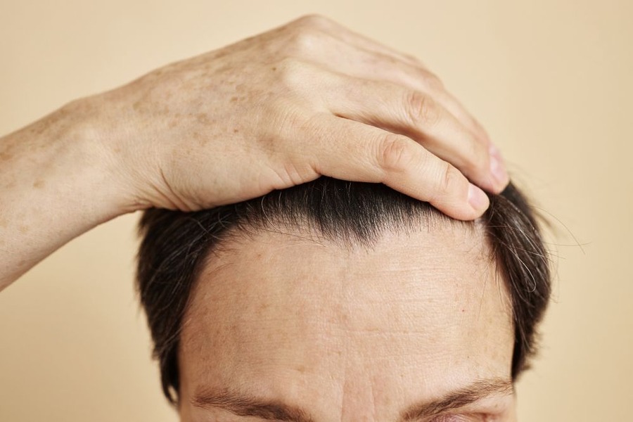 Frontal Balding