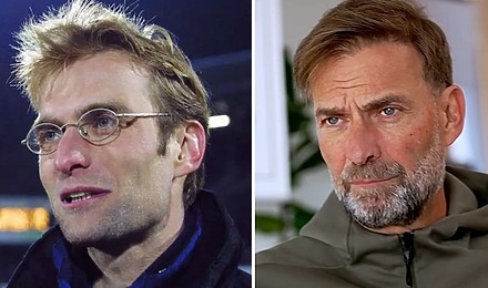 Jurgen Klopp Hair Transplant