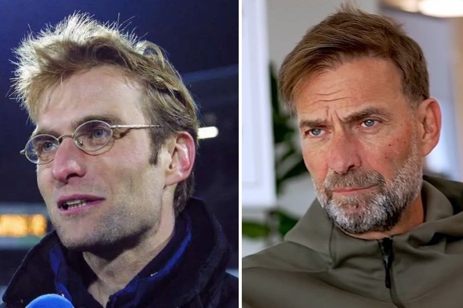 Jurgen Klopp Hair Transplant