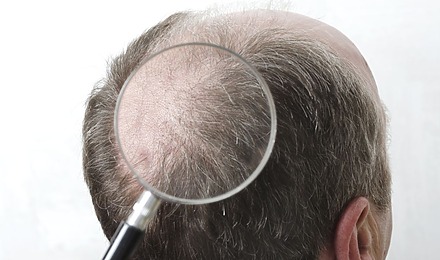 Double Crown Vs Balding