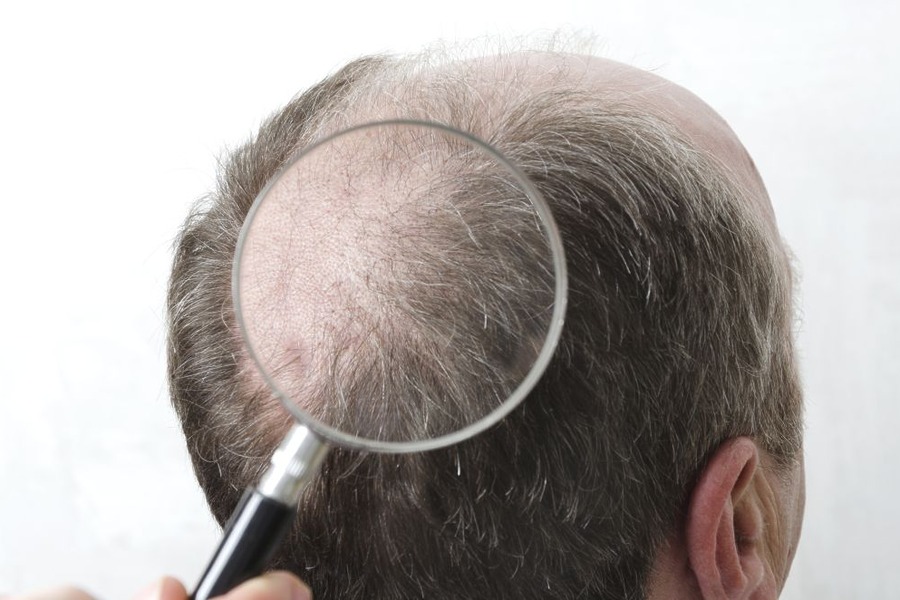 Double Crown Vs Balding