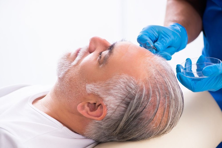 Hair Transplant Death Rate