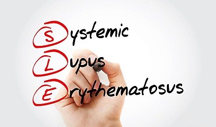 Lupus Hair Loss