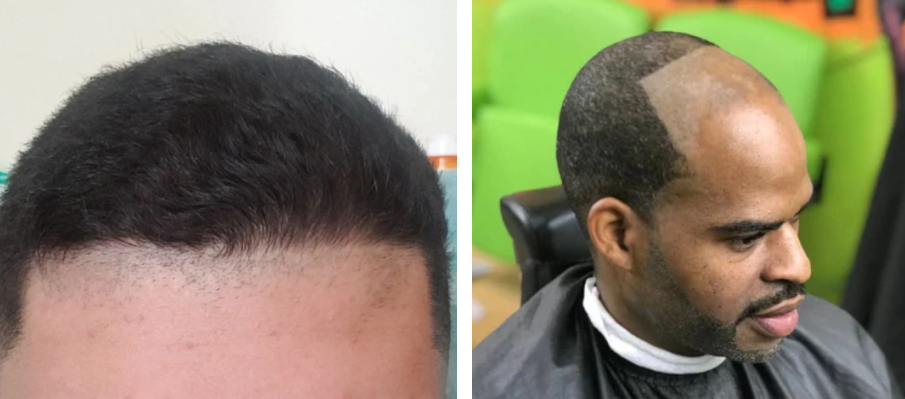 how to fix a bad hairline