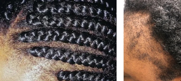 hair loss from traction alopecia